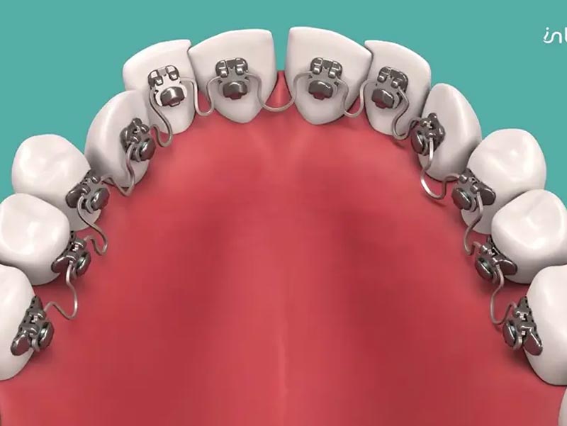 Featured image for “Inbrace Treatment: What to Expect During Your Behind-The-Teeth Braces Journey”