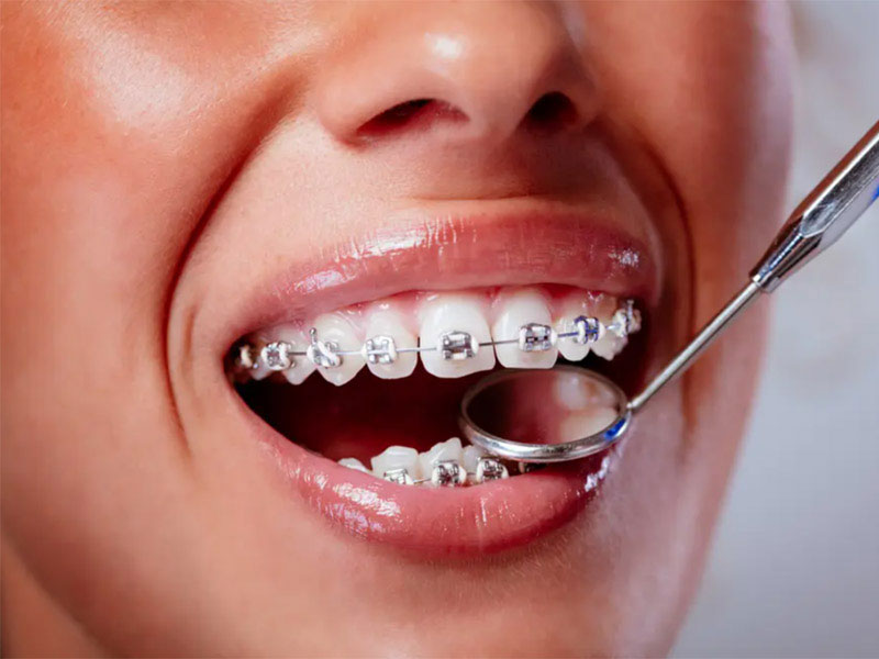 Featured image for “Overcoming Speech Problems With Orthodontic Care”