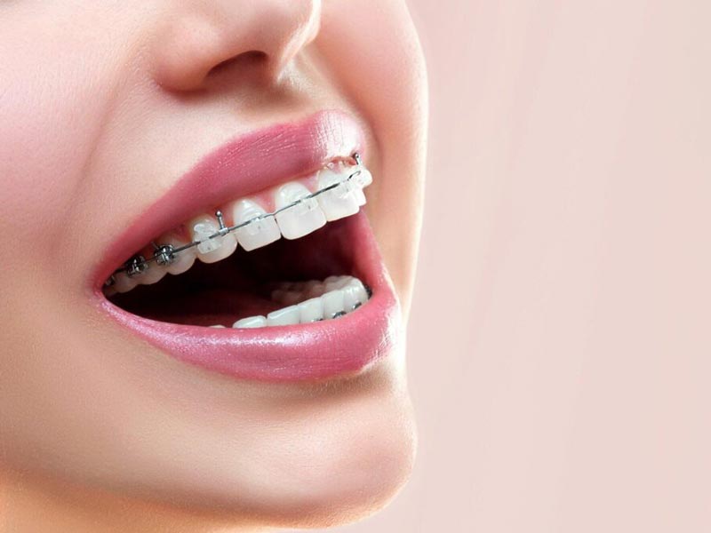 Featured image for “How to Prevent White Spots on Teeth During Braces Treatment”