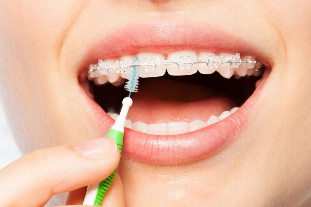 Close-up of teeth with clear braces being cleaned using an interdental brush