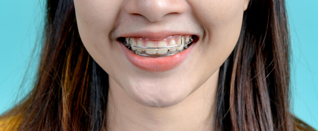 a woman wearing braces smiling