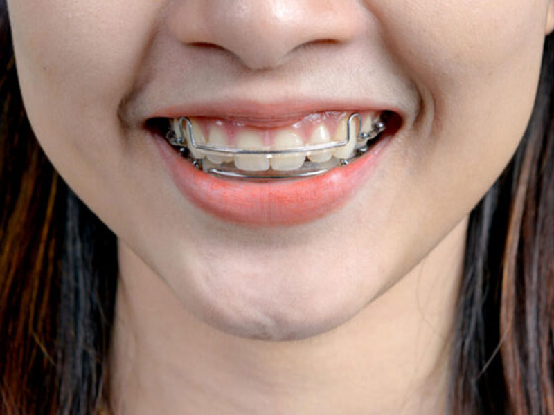 Featured image for “Retainers: The Key to Maintaining Your Perfect Smile Post-Treatment”