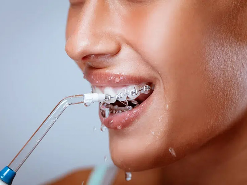 Featured image for “What to Know About Water Flossers for Braces”