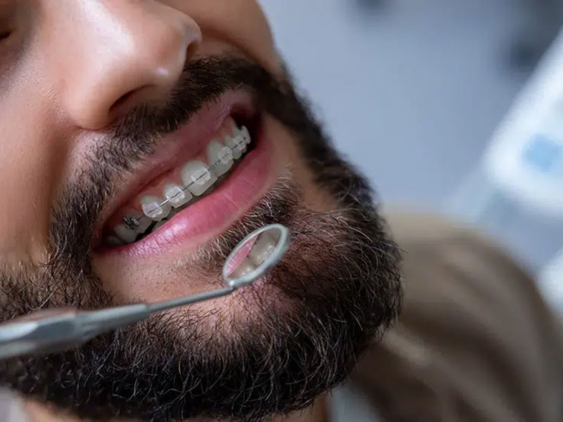 Featured image for “How Long Will I Need to Wear Braces?”