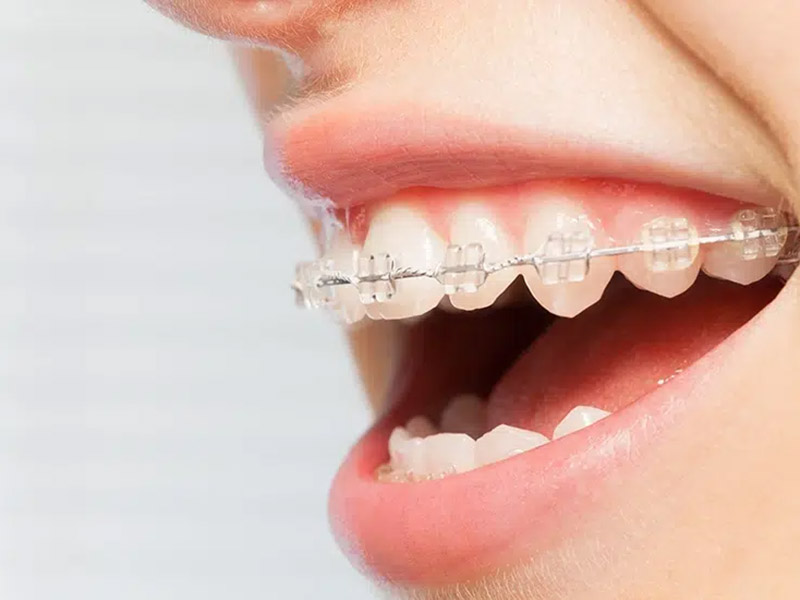 Featured image for “Metal Braces vs. Ceramic Braces: What’s the Difference?”