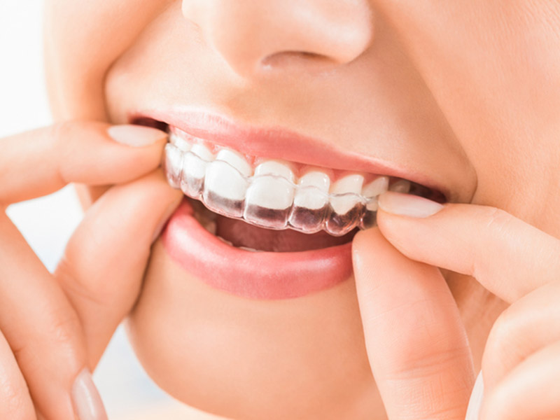 Featured image for “7 Benefits of Getting Invisalign as an Adult”