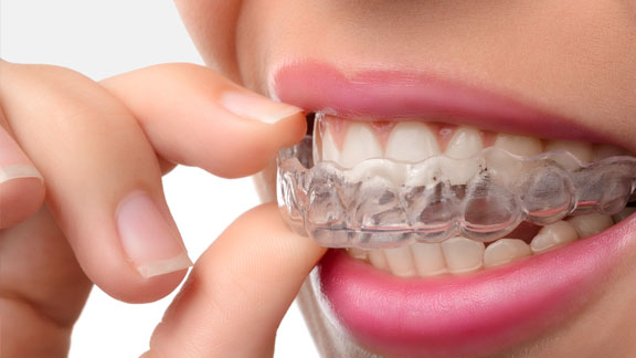 Braces, Invisalign & Adult Orthodontics  SouthShore Orthodontics in  Riverview, FL