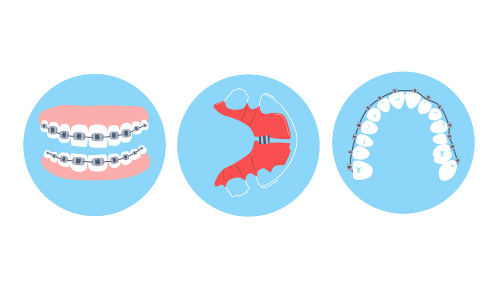 My Last Braces Checkup - Bending orthodontic wire - Tooth Time